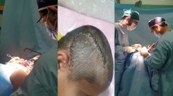 جراحی اورژانسی و موفقیت‌آمیز خونریزی مغزی کودک ۹ ساله در گناباد